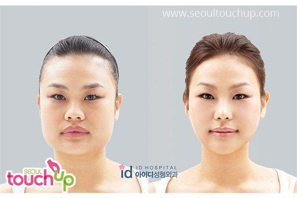 Ci-Ci D. reccomend Asian nose augmentation